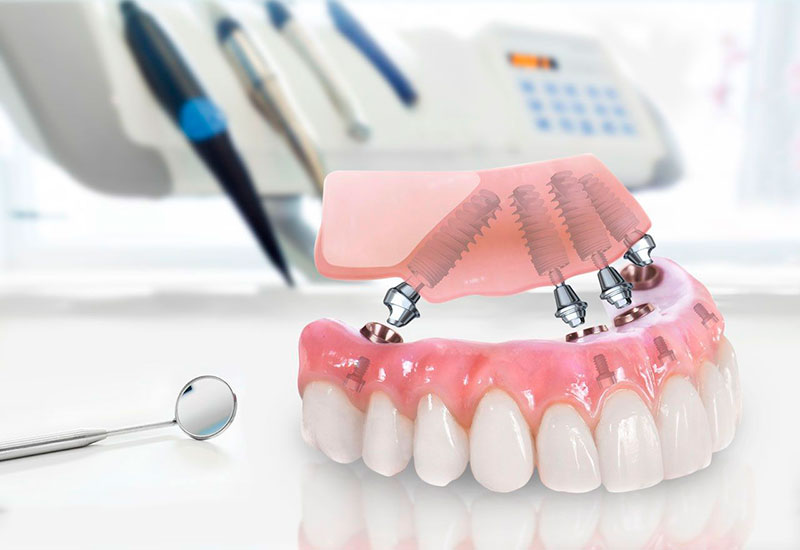 Методика имплантации зубов Все на 4х